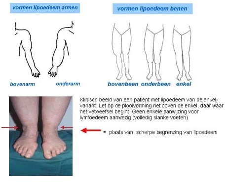 afbeelding bij Lipoedeem